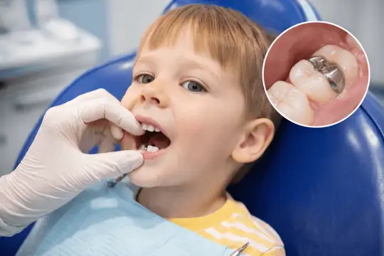 Зачем ребенку ставят коронку